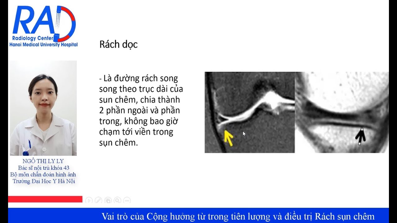 Vai trò của Cộng hưởng từ trong tiên lượng và điều trị chấn thương khớp gối có rách sụn chêm