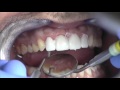 Prepless veneers procedure from cosmetic dental associates in san antonio tx