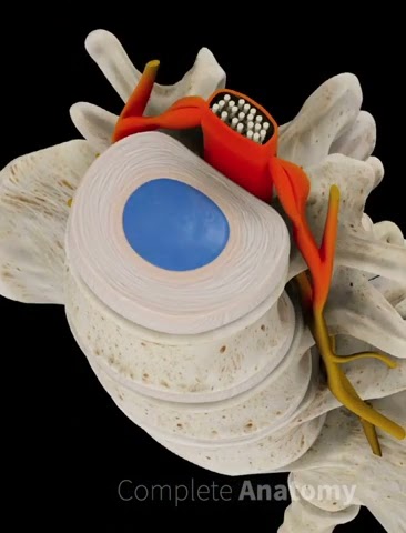 Epidural Injection