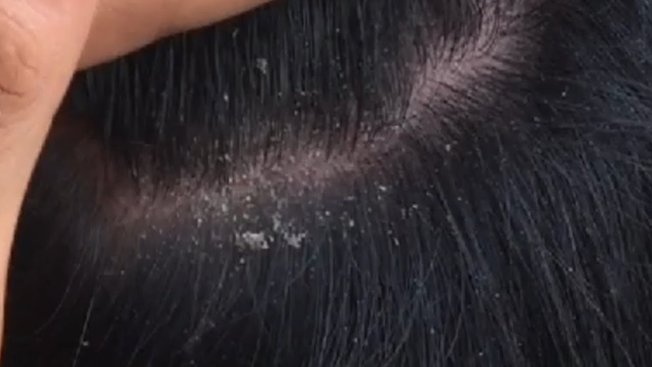 Dandruff Removal / Dandruff Extreme / Dandruff Scratching ASMR