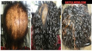 This video is about a client i have with alopecia. done crochet weave
on netted cap. great technique for hairloss. check out my mor...