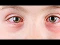 Mayo Clinic Minute - What is pink eye?