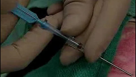 Central line placement