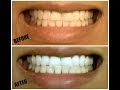 Teeth Whitening at Home