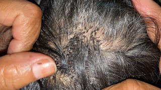 Wife Removed Husband Lices Super Video Long Hair Lice Remove Part20