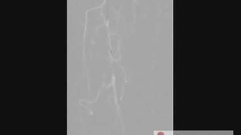 Subintimal Angioplasty