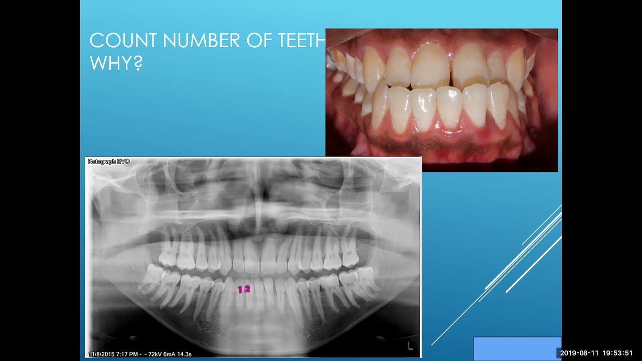INTRAORAL EXAMINATION , ORTHODONTIC DIAGNOSIS 1 YouTube