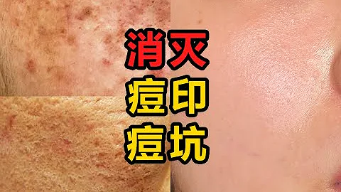 痘印痘疤全攻略，多年痘印有救了 - 天天要闻