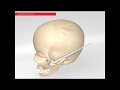 Distraction osteogenesis  32 options from kls martin