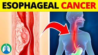 Top 10 Early Warning Signs of Esophageal Cancer ⚠️ by Respiratory Therapy Zone 2,025 views 10 days ago 9 minutes, 44 seconds