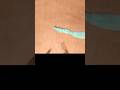 INTRACORPOREAL KNOT TYING - LAPAROSCOPIC APPENDECTOMY #surgeon #surgeryrecovery #laparoscopysurgery