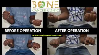 Giant cell tumour GCT of wrist bone treated by Dr Rajat Gupta