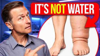 Lymphedema: What Doctors Don't Tell You (Diet Connection)