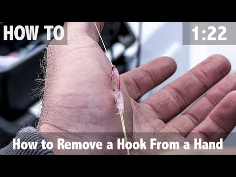 How to Remove a Hook from a Hand 