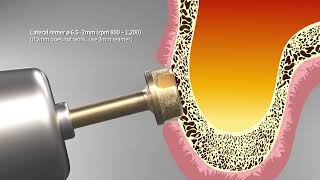 Information Hydraulic Sinus Lifting Kit News