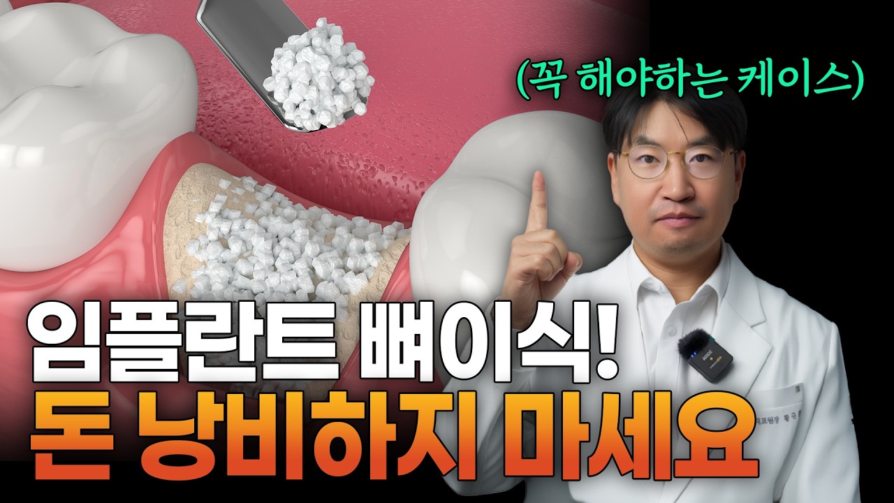 ⚠️임플란트 뼈이식, 무조건! 하지 마세요(이런 분들만 하시면 됩니다)