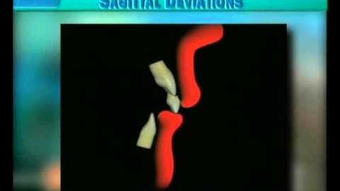 Clip 31: Eruption and Transition of Central Incisors in Severe Class II/1 with Lip-Interposition