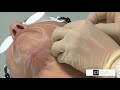 Cómo se hace un lifting facial con Endolight Lift - Cirugía antienvejecimiento con laser