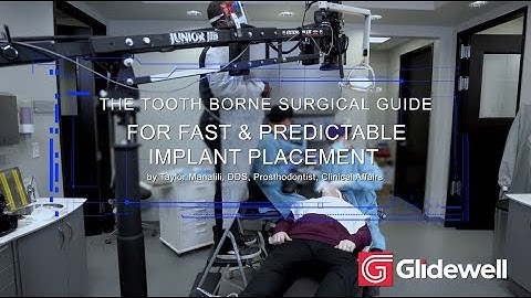 Tooth Borne Surgical Guide for Fast & Predictable Implant Placement
