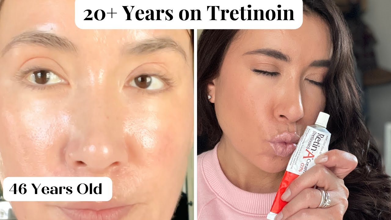 Before and after 3 months of Tret 0025 with Niaciamide and Azaelic acid  Do the bagsdark circles look improved at all This is from a lifetime of  no skincare routine to having