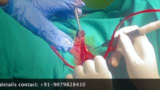 Live Labiaplasty Surgery With Wedge Technique - By Dr Mayuri Kothiwala Labia Minora Reshaped