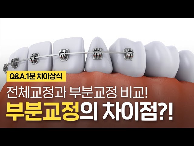 부분교정과 전체 치아교정의 차이는!? ⏰1분 치아상식!!