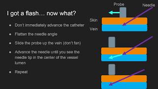 Pem Pearls Ultrasound Guided Peripheral Ivs