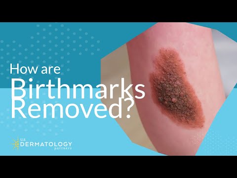 Video: Birthmark Inflamed: What To Do, Which Doctor To Contact