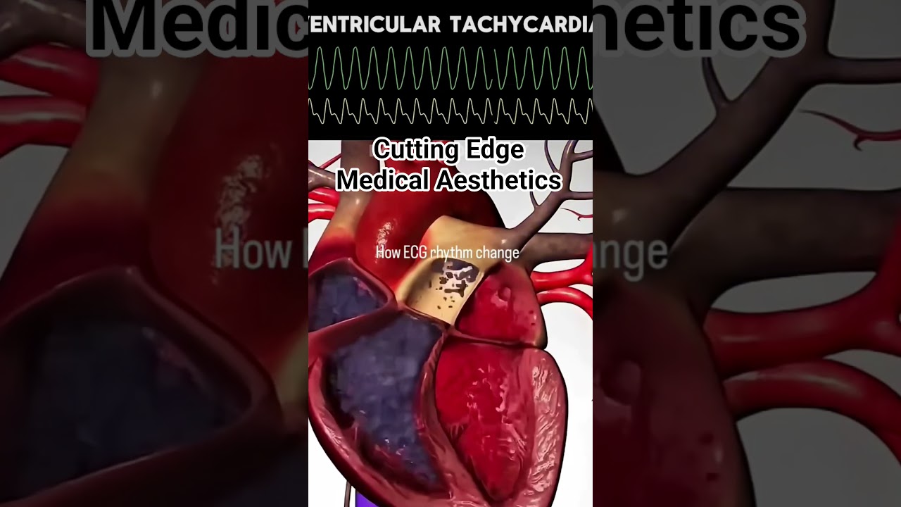 Normal Heart Rhythm vs Dangerous Arrhythmias (ECG Explained)