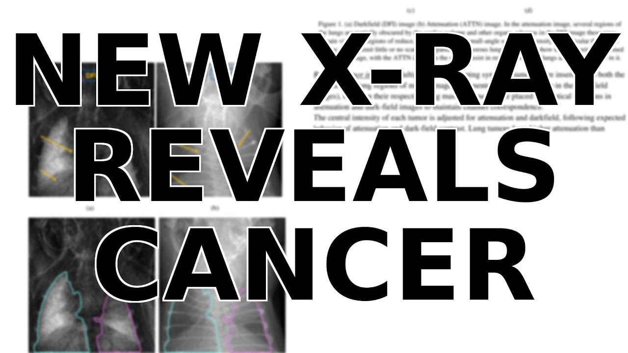 This New X-Ray Tech Lets AI Find Lung Cancer Regular X-Rays Miss