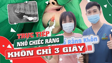 TRỰC TIẾP NHỔ RĂNG KHÔN CHƯA ĐẾN 1 PHÚT | Nhổ răng tại Nha khoa Italiano |