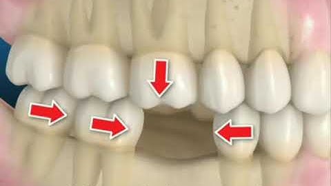 Consequences of not replacing missing tooth