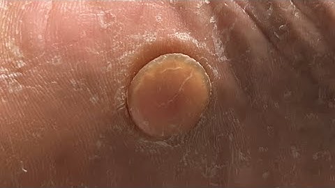 What is this Bump on the Foot?