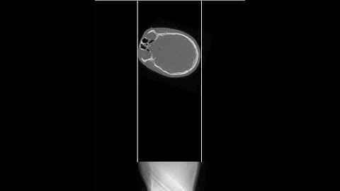 Radon Transform: Head