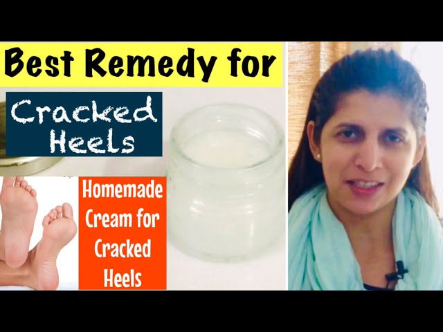 Best Natural Home Remedy for Cracked heels | Get smooth feet with easy  homemade Cream | In Hindi - YouTube