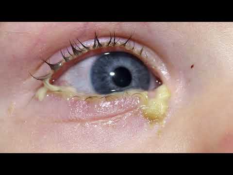 Why Do We Get Eye Boogers? 