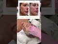 Can one skin-tightening treatment really make a noticeable difference? 👀
