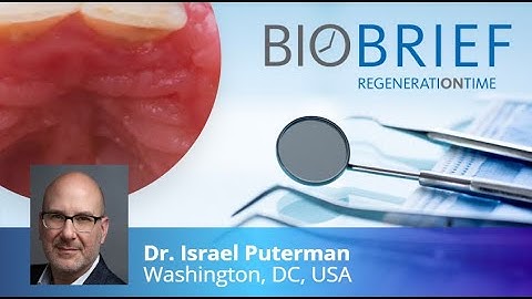 Geistlich Fibro-Gide®: Correction of Maxillary Anterior Soft Tissue Peri-implant Ridge Deficiencies