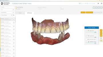 Tutorial - From Connect Case Center Inbox to exocad Implant Jaw Scan