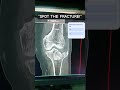 👉 “Dangerous Knee Injury 😨 | CT Scan Reveals Hidden Fracture!” #shortsfeed #viralvideo