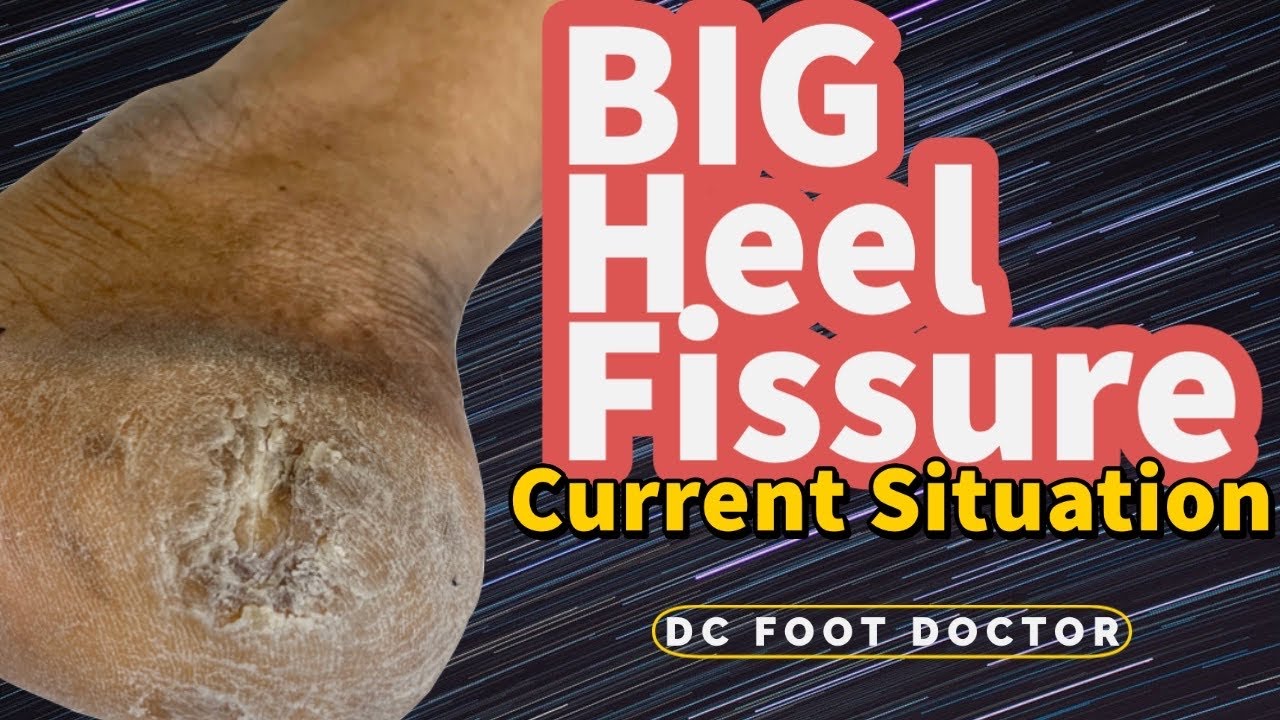 SKV TRADERS Anti Crack Full Length Silicon Moisturizing Heel Pads Heel  Socks Pain Relief Heel Cracks Foot Care Protector Pedicure Support for Men  and Women Unisex (HEEL SOCKS) -