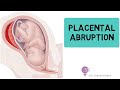 Placental abruption