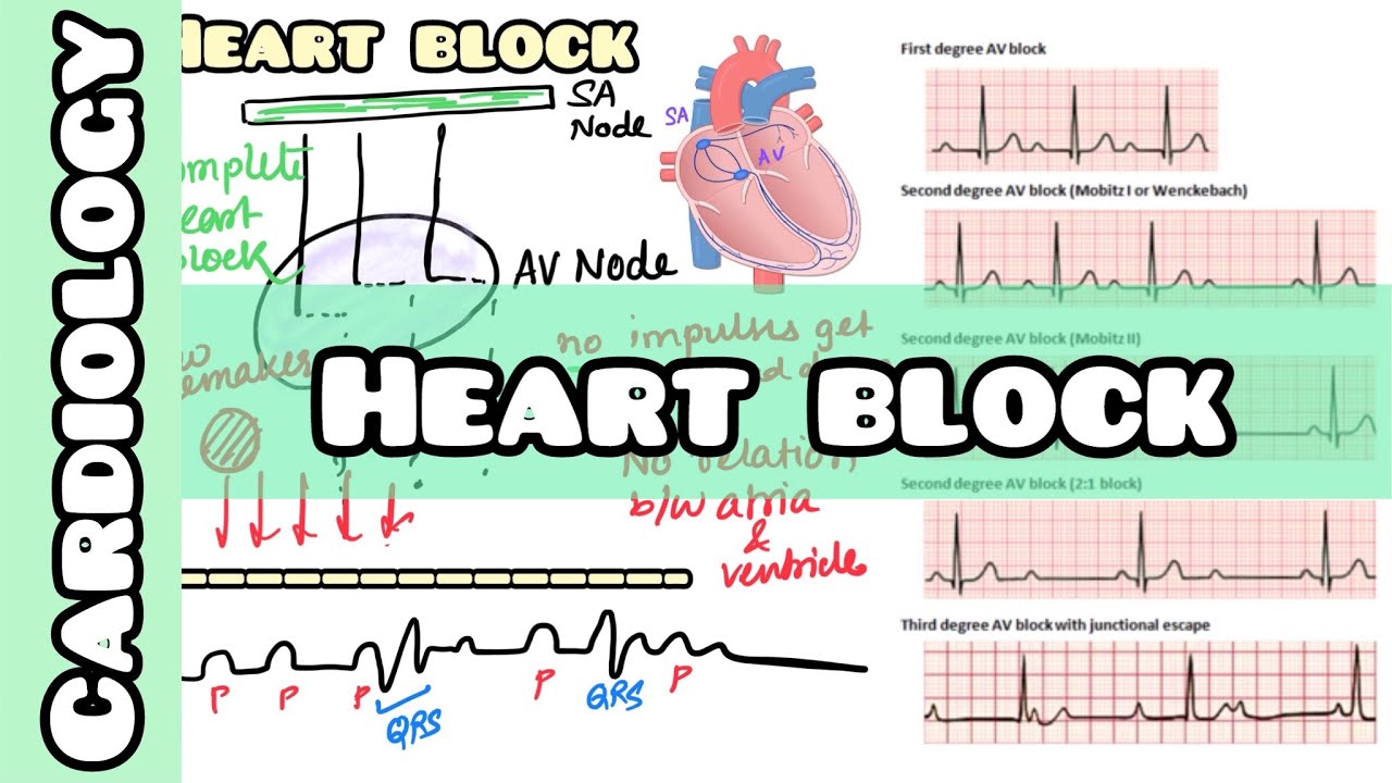 heart-block-made-simple-for-usmle-neet-pg-nclex-youtube