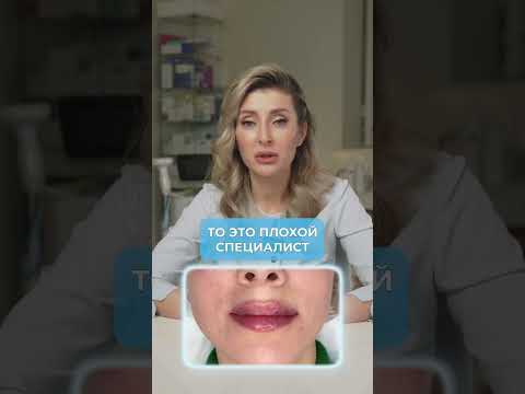 Почему синяки на губах после косметолога? #косметология #губы #красота