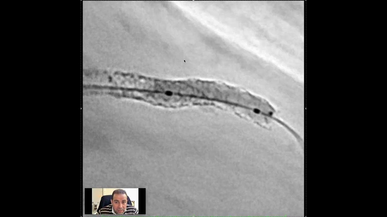 ISR with Cutting and DCB