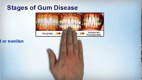 Understanding Gum Disease(Dr. Deborah G. Anders - ...
