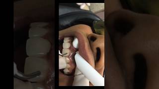 Got uneven gums ? Painless, easy laser procedure to correct a gummy smile 😊