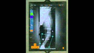 Bone Ninja App: How to Simulate Osteotomies and Corrections screenshot 1