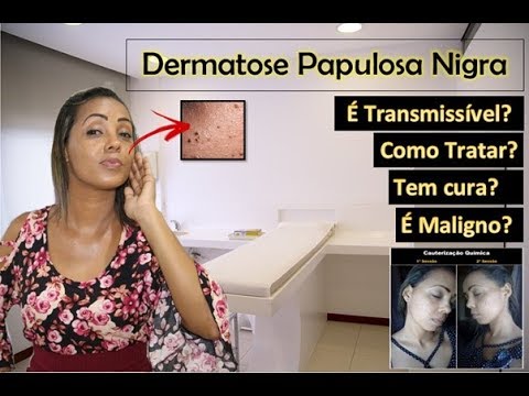 Vídeo: Dermatose Papulosa Nigra: Aparência, Causas E Remoção