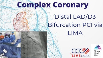 Distal LAD/D3 Bifurcation PCI via LIMA